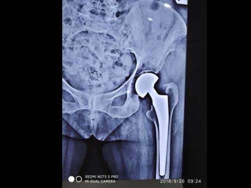 old damaged joint is replaced with artificial hip joint prosthesis 