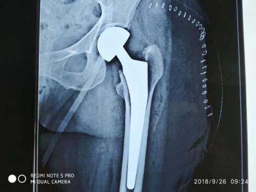 hip joint replacement surgey in 96 yr old patient