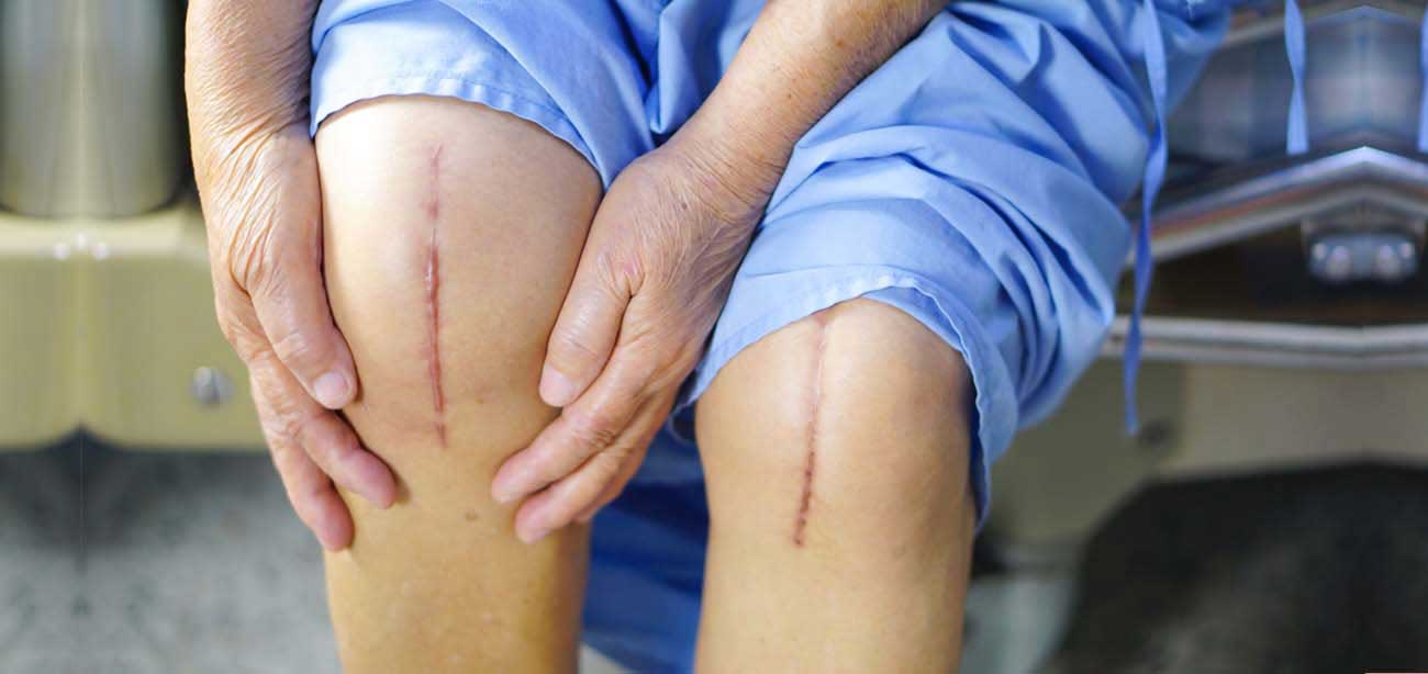 knee replacemnet surgery scar