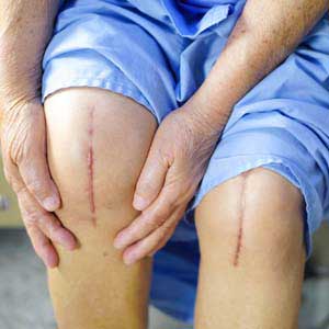 knee replacemnet surgery scar