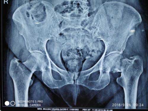 pelvic xray of 96 yr old female patient